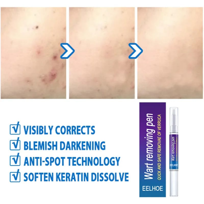 Skin Tag Wart Mole Remover Pen Woman Skin Care Removing Against Moles Pimple Patch Remove Black Dot