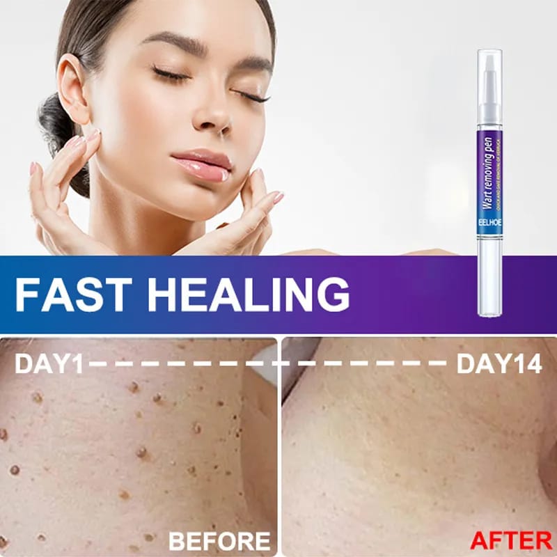 Skin Tag eye Wart Mole Remover Pen Woman Skin Care Removing Against Moles Pimple Patch Remove Black Dot