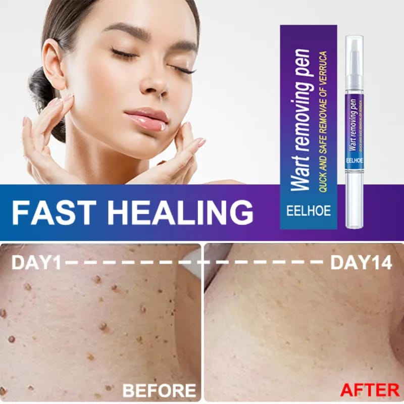 Skin Tag eye Wart Mole Remover Pen Woman Skin Care Removing Against Moles Pimple Patch Remove Black Dot