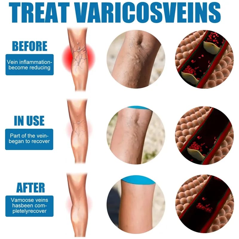 30ml Vein Healing Varicose Veins Treatment Spray Essential Oil Relief Phlebitis Angiitis Remedy Pain Spray Relief Leg Pain Spine Pain
