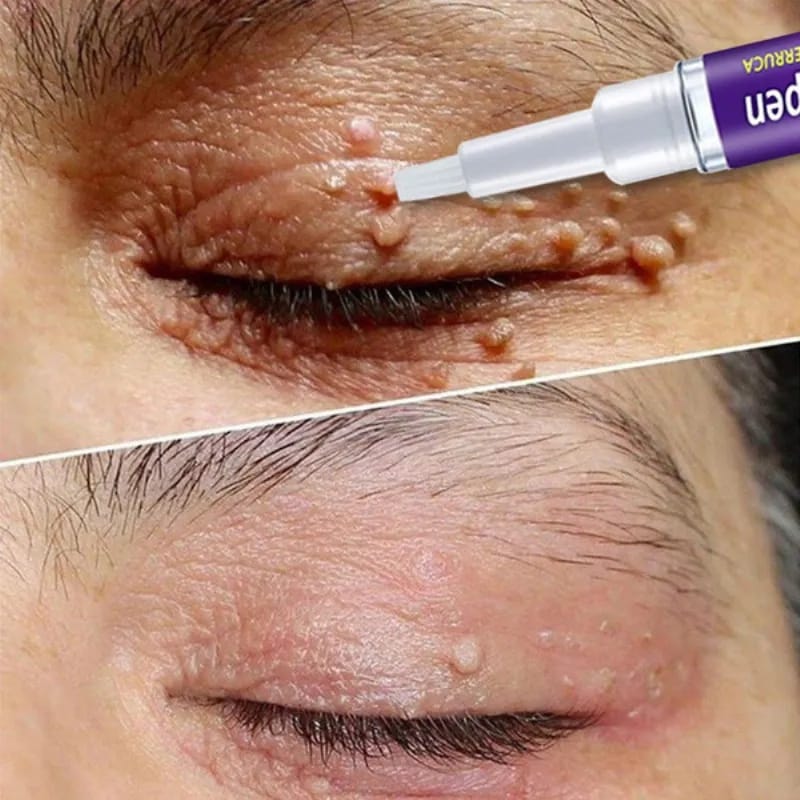 Removal Of Warts Liquid Pen Woman Skin Care Removing Against Moles Patch Remove Black Dot Emulsion