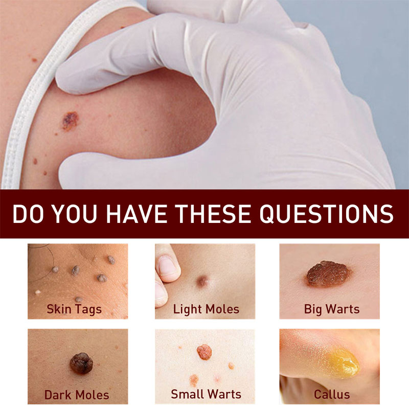 Removal Of Warts Liquid Pen Woman Skin Care Removing Against Moles Patch Remove Black Dot Emulsion Beauty Health Cosmetic