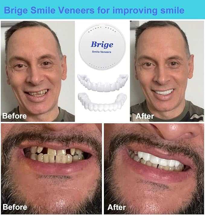 Snap On Smile Veneers Instant Teeth Cover – Temporary Cosmetic Fake Teeth
